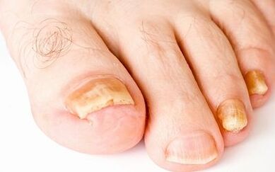 Foto simptomi gljivice noktiju