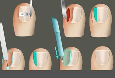Uklanjanje nokta u prisustvu gljivice na nogama