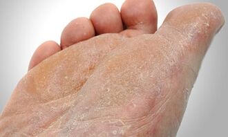 Staze mjenjača gljivice stopala