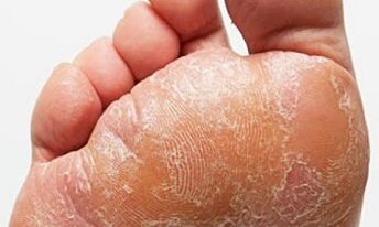 Znakovi i simptomi gljivice na nogama