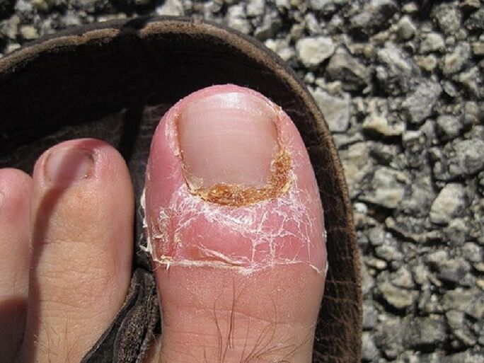 oštećenje noktiju i kože prstiju zbog gljivične infekcije